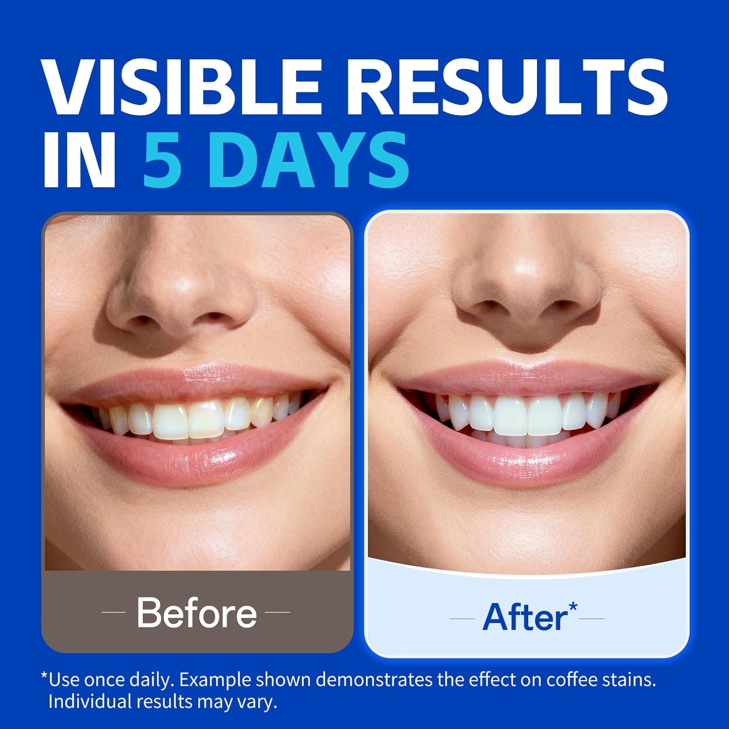 1/7쌍 치아 미백 스트립, 더 하얗게 보이는 미소를  - Teeth Whitening Retainer 리뷰 및 가격