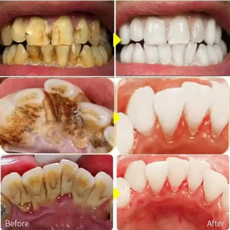 빠른 치아 미백 치약 펜 플라크 얼룩 제거 구강 위생  - Whitening Pen Bleach 리뷰 및 가격