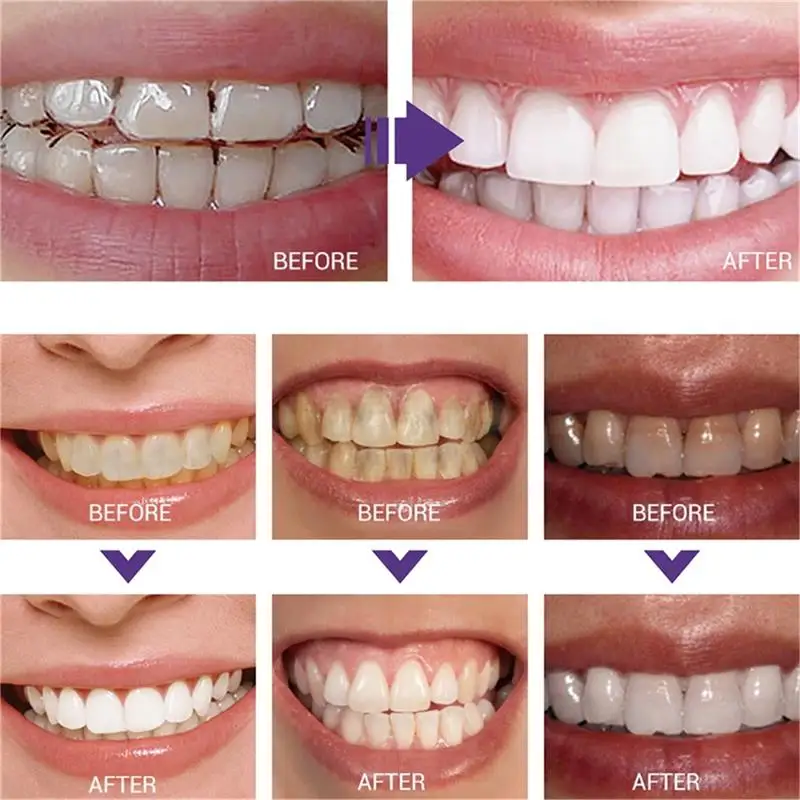 빠른 치아 미백 치약 펜 플라크 얼룩 제거 구강 위생  - Whitening Pen Bleach 리뷰 및 가격